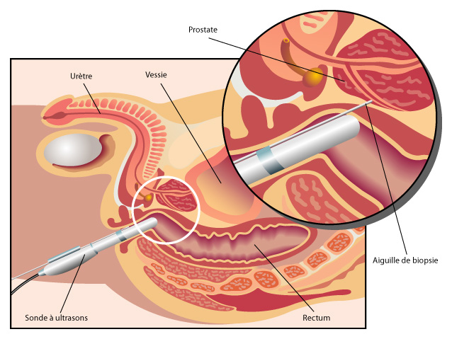 biopsy de la prostate