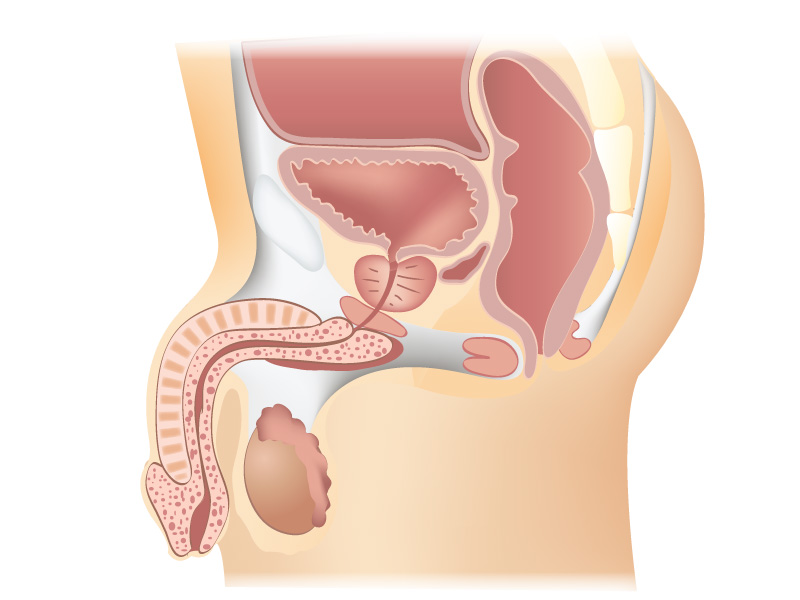 chirurgie prostate