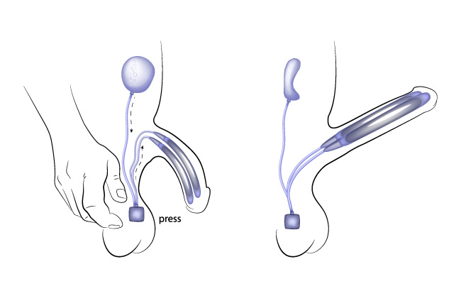 Implant pénien