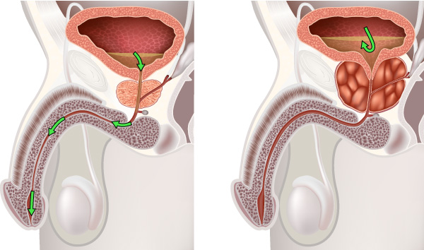 chirurgie prostate