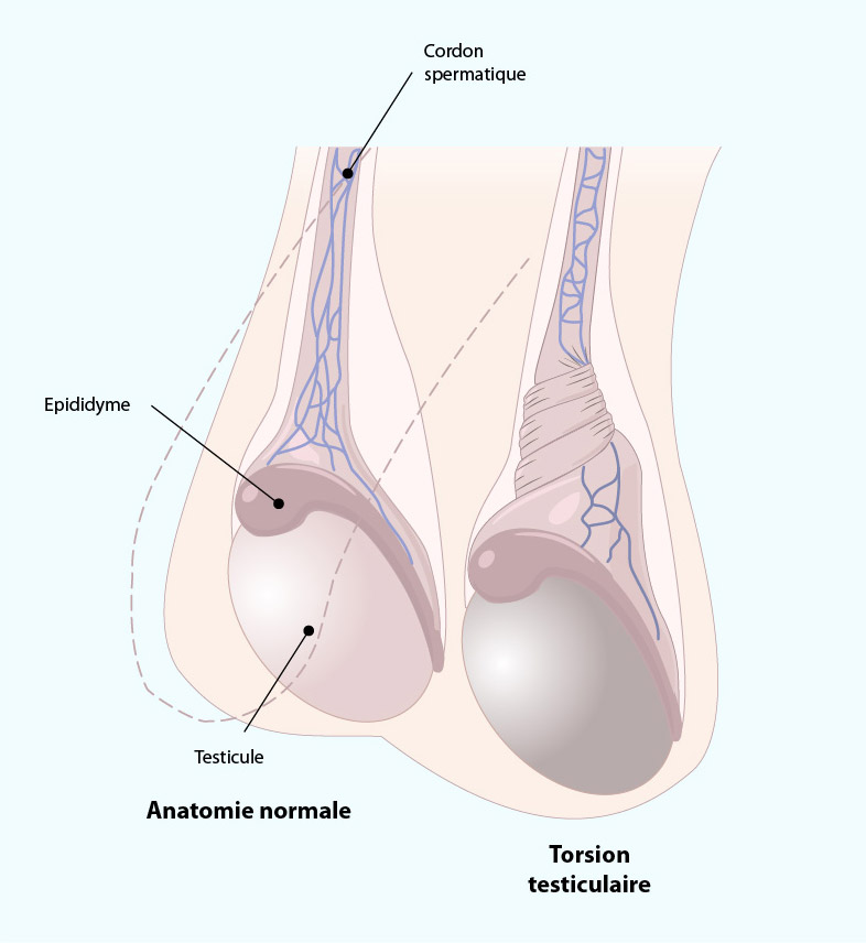 la torsion de testicule