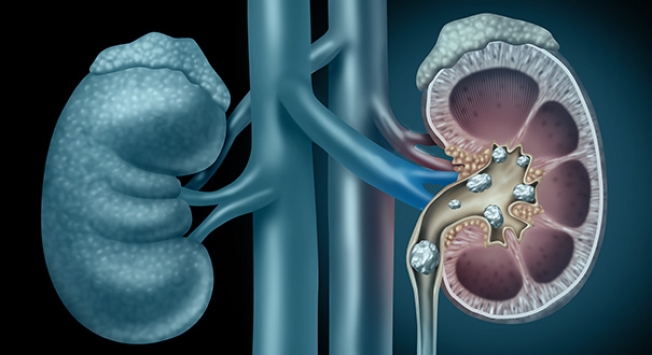 Calculs rénaux-coliques